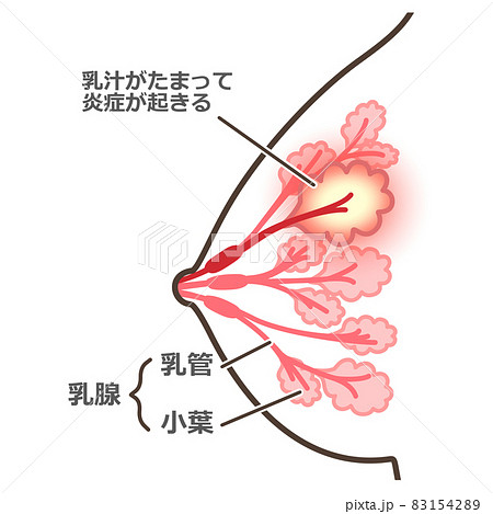 乳腺炎のイラスト　説明付 83154289