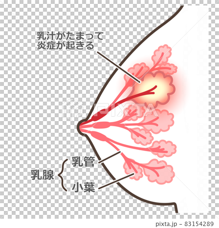 乳腺炎のイラスト　説明付 83154289