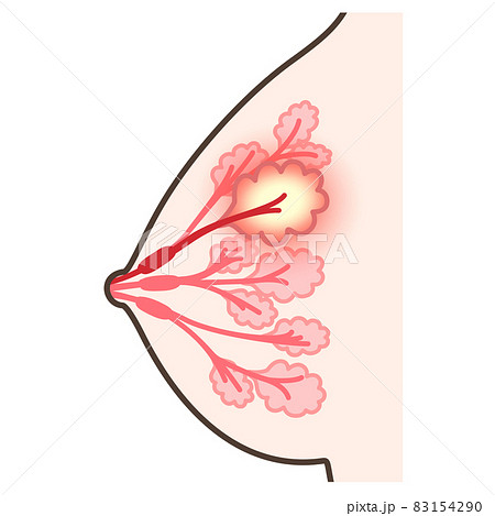 乳腺炎のイラスト 83154290