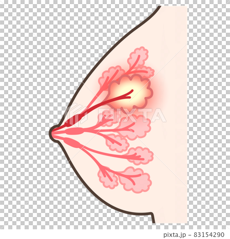 乳腺炎のイラスト 83154290