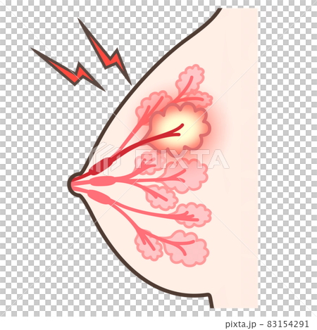 乳腺炎のイラスト 乳腺炎のイラスト 83154291