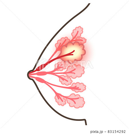 乳腺炎のイラスト 83154292