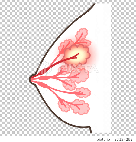 乳腺炎のイラスト 83154292