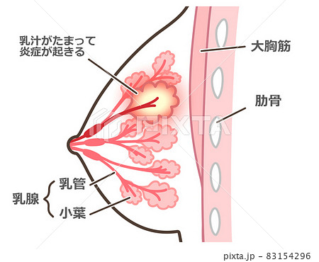 乳腺炎のイラスト　説明付 83154296
