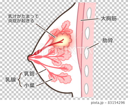 乳腺炎のイラスト　説明付 83154296
