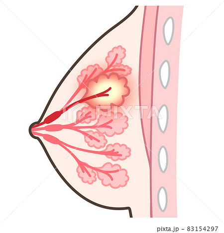 乳腺炎のイラスト 83154297