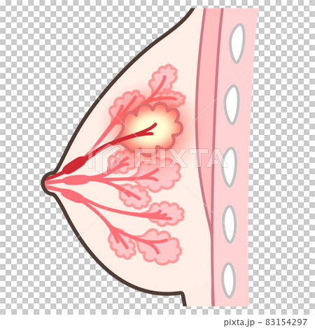 乳腺炎のイラスト 83154297
