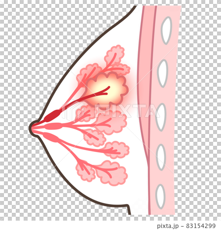 Illustration of mastitis 83154299