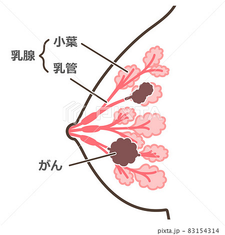 乳がんのイラスト 説明付 83154314