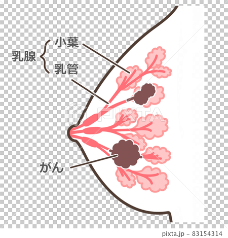 乳がんのイラスト 説明付 83154314