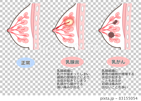 胸の病気のイラスト 83155054