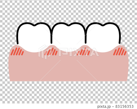 牙齦和牙齒紅腫 83156353
