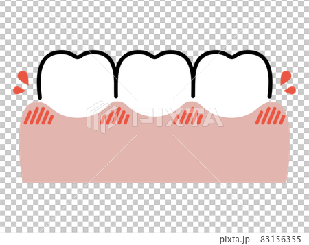 牙齦和牙齒腫脹和出血 83156355