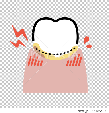 中度の歯周病の歯（1本） 83185494