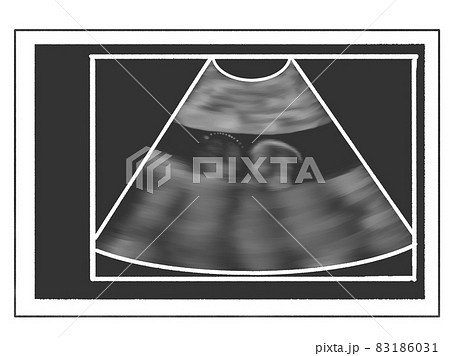 エコー写真風のイラスト 妊娠5か月(18週ごろ) エコー写真風のイラスト 妊娠5か月(18週ごろ) 83186031