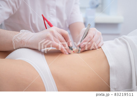 Woman on electro epilation on her tummy. Permanent hardware removal of unwanted abdominal hair. 83219511