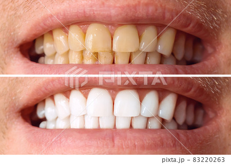 Teeth before and after whitening. Over white background. Dental clinic patient. Image symbolizes oral care dentistry, stomatology. Teeth before and after whitening. Over white background. Dental clinic patient. Image symbolizes oral care dentistry, stomatology. 83220263