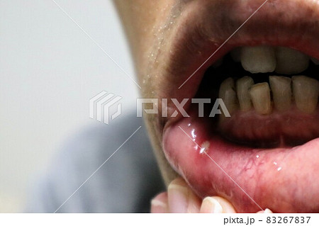 口内炎になった人物のクローズアップ 口内炎になった人物のクローズアップ 83267837