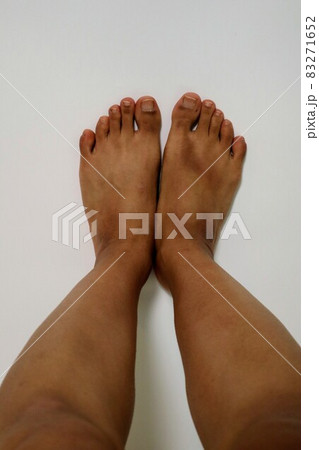 脱毛後の日本人男性の脚 脱毛後の日本人男性の脚 83271652