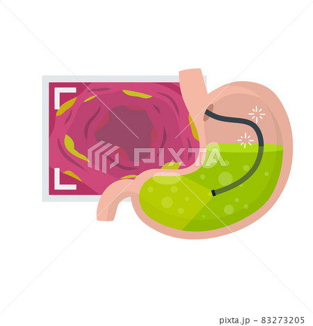 Gastroscopy. Endoscopy and digestive problems. Hose with camera 83273205