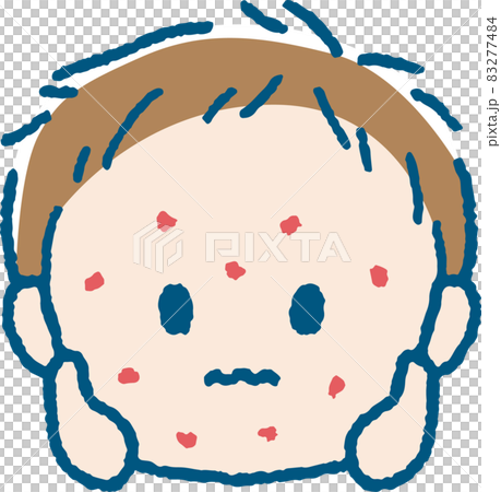 Illustration of a boy with a rash Illustration of a boy with a rash 83277484