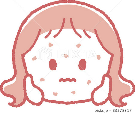 湿疹が出た女の子のイラスト 湿疹が出た女の子のイラスト 83278317