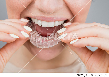 Close-up portrait of a woman putting on a transparent plastic retainer. A girl corrects a bite with the help of an orthodontic device 83287723