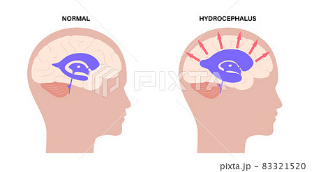 Ventricular system concept 83321520
