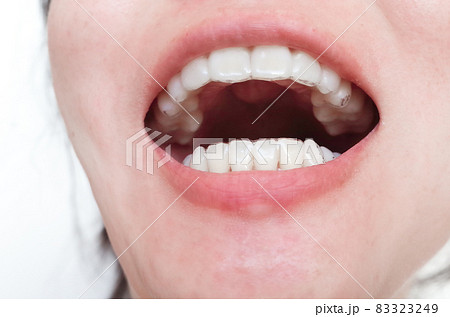 矯正のマウスピース 83323249