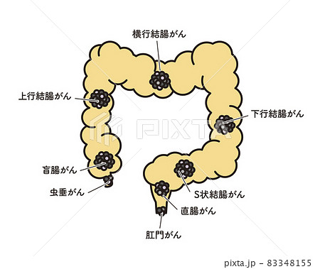 シンプル　イラスト　大腸のがん発生部位 83348155