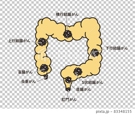 シンプル　イラスト　大腸のがん発生部位 83348155