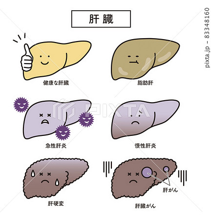 シンプル　イラスト　肝臓　脂肪肝　慢性肝炎　急性肝炎　肝硬変　肝臓がん 83348160