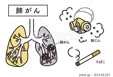 シンプル　イラスト　肺がんの原因　たばこ　粉じん 83348165
