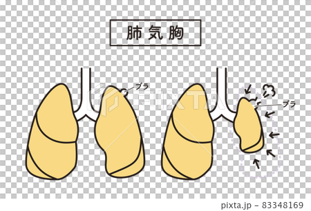 シンプル イラスト 肺気胸 シンプル イラスト 肺気胸 83348169
