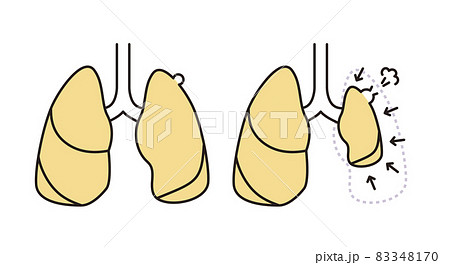 シンプル イラスト 肺気胸のイラスト素材