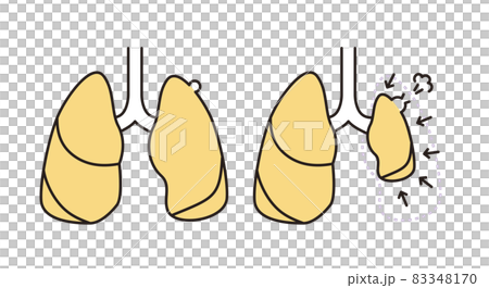 Simple illustration lung pneumothorax Simple illustration lung pneumothorax 83348170