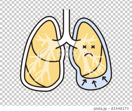 Simple illustration pleural effusion lung 83348173