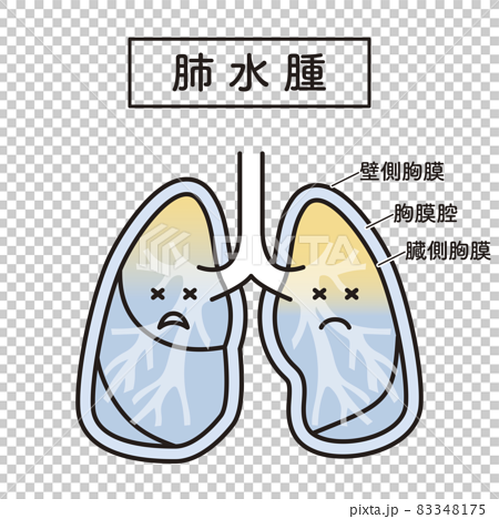 Simple Illustration Pulmonary Edema Lung Stock Illustration