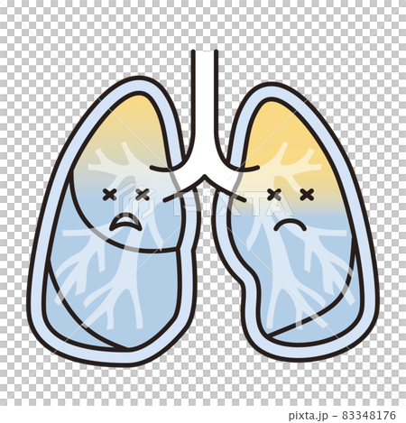 Simple illustration: Pulmonary edema lung 83348176