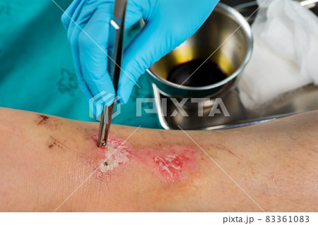 close up doctor cleaning wound on leg, Injuries from falling close up doctor cleaning wound on leg, Injuries from falling 83361083