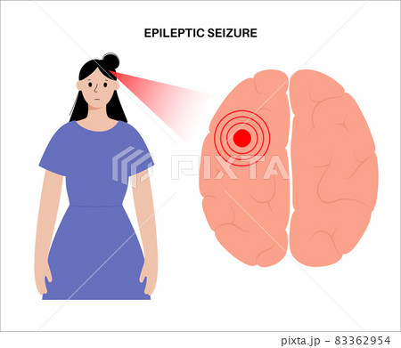 epilepsy seizure concept 83362954