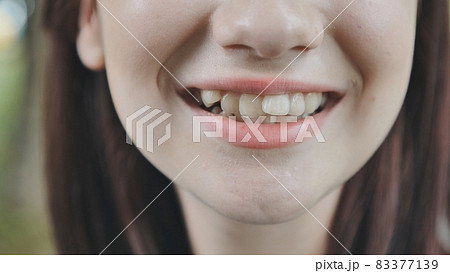 A teenage girl demonstrates her crooked teeth. A teenage girl demonstrates her crooked teeth. 83377139