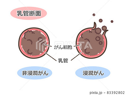 乳がんの乳管断面図 乳がんの乳管断面図 83392802