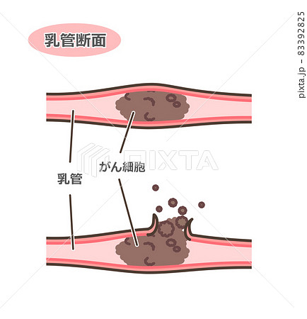 乳がんの乳管断面図 83392825