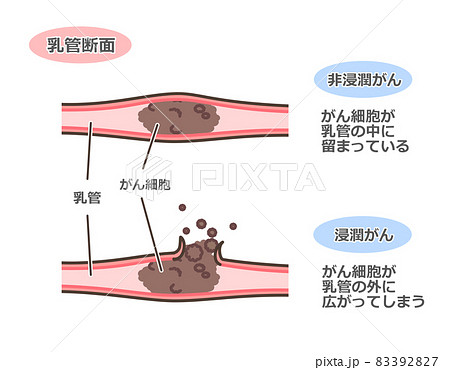 乳がんの乳管断面図 83392827
