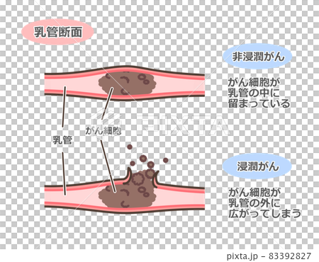 乳がんの乳管断面図 83392827
