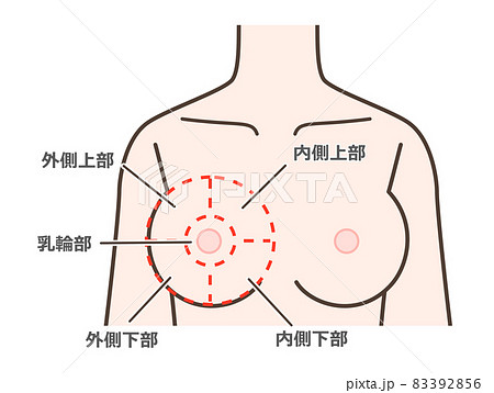 乳がんなど好発部位の説明イラスト 乳がんなど好発部位の説明イラスト 83392856