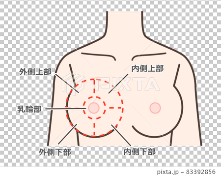 Illustrations explaining the most common areas such as breast cancer Illustrations explaining the most common areas such as breast cancer 83392856