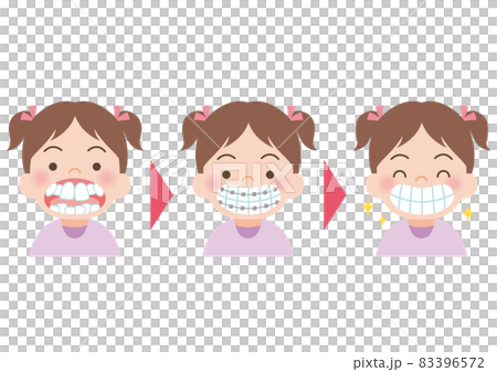 歯ならびの矯正をする女の子 83396572
