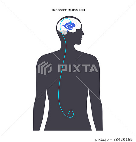 hydrocephalus shunt concept hydrocephalus shunt concept 83420169